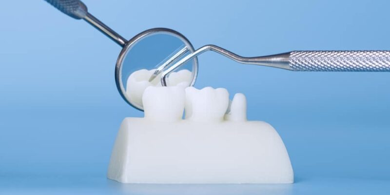 Dental Bridges Jefferson