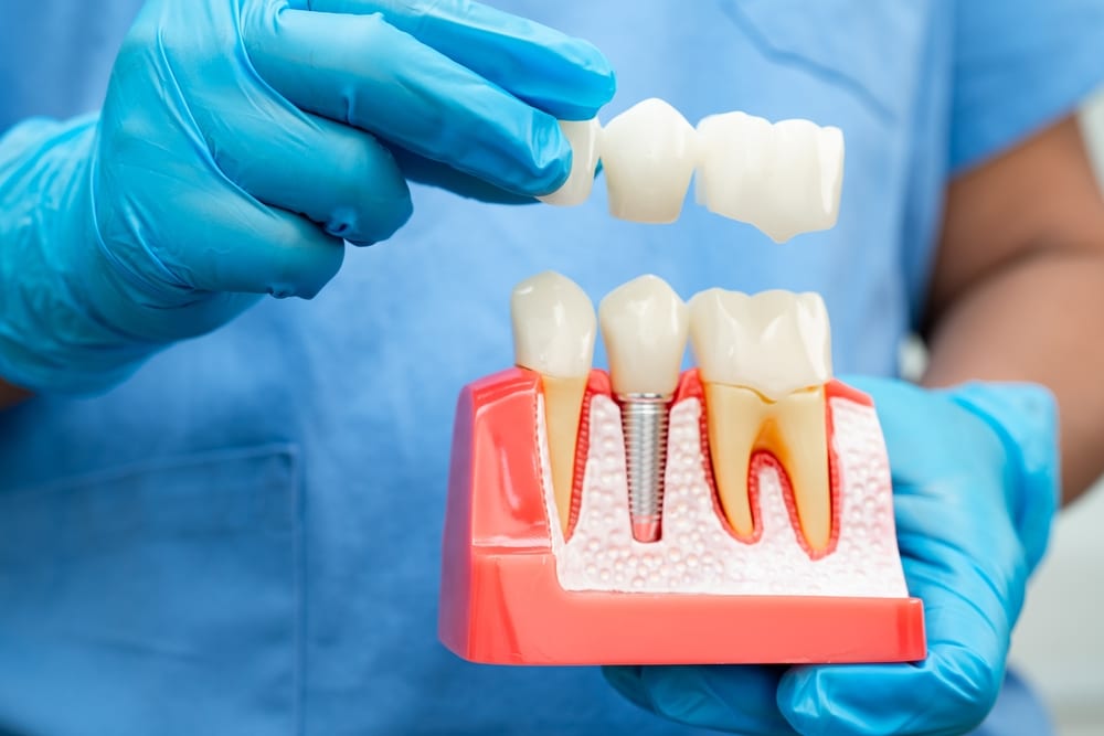 Dental Implants Jefferson