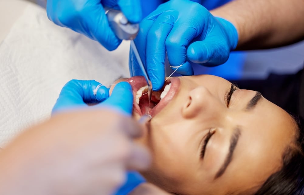 veneers maintenance